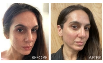 Before and After photos of Fraxel treatment